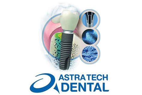 5 Ways Astra Tech Implant Revolutionizes Healthcare