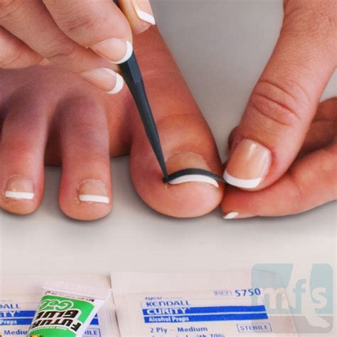 5 Ways Nail Techs Treat Ingrown Toenails