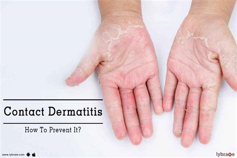 7 Ways To Prevent Contact Dermatitis In Nail Tech