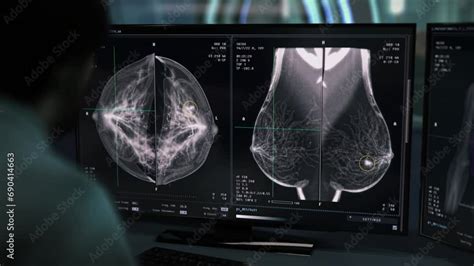 Advances In Mammography Technology For Breast Cancer Detection