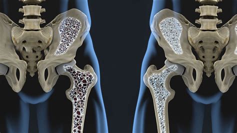 Boosting Bone Health With Advanced Density Technology